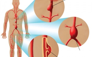 Cứu sống bệnh nhân vỡ động mạch chủ ở bụng