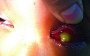 Mất mắt vì đắp lá dâm bụt