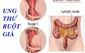 Phát hiện sớm để trị dứt điểm ung thư ruột già
