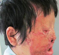 Tự hủy dung nhan vì lột da bằng axit