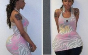 Mỹ bỏ tù bác sĩ thẩm mỹ bơm mông bằng... cao su