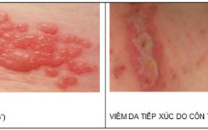 Phân biệt viêm da côn trùng và giời leo?