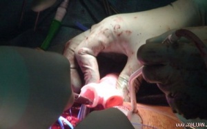 Ghép thành công khí quản tạo từ tế bào gốc