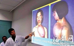 3 ca phẫu thuật cấy ghép khó tin nhất