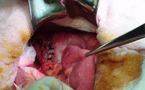 Hậu Giang: Bệnh nhân hoại tử ruột sau phẫu thuật