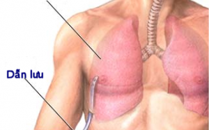 Adempas được sử dụng điều trị tăng áp lực động mạch phổi