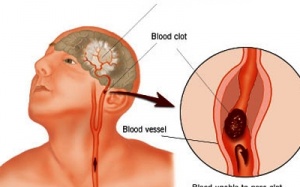 Tai biến mạch máu não: Những điều cần biết