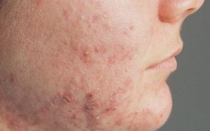 Chết vì thuốc trị mụn?