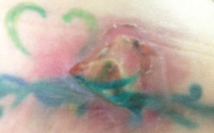 Đi mát-xa tan mỡ,  bị nhiễm trùng vùng bụng