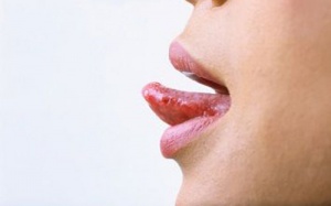 Lưỡi rát là bệnh gì?