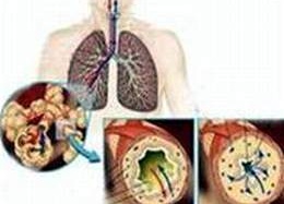 Việt Nam có 9 triệu người mắc phổi tắc nghẽn và hen phế quản