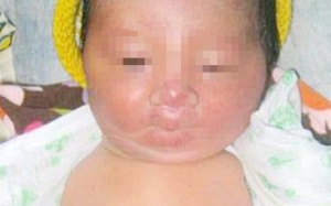 Trường hợp hy hữu: Bé trai sơ sinh không có tay chân