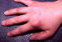 Dấu hiệu và cách trị viêm khớp tự phát ở trẻ