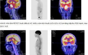 Chữa khỏi ung thư ở Việt Nam sau khi bệnh viện Singapore 'trả về'