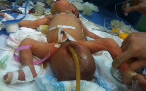 Phẫu thuật thành công khối u lớn ở hậu môn cho bé sơ sinh