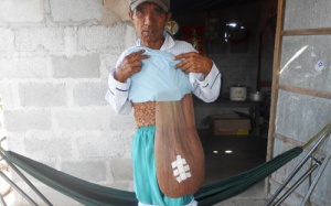 Người đàn ông mang cục bướu 5 kg gần 10 năm nay