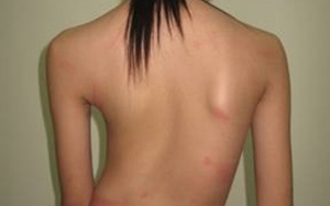 Phòng tránh cong vẹo cột sống cho con yêu