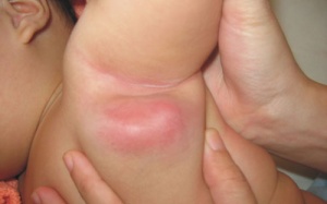 Nổi hạch to có phải ung thư?