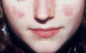 Thuốc cá thể hóa - hướng tiếp cận mới với bệnh Lupus