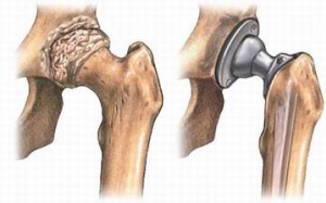 Khánh Hòa: 51 bệnh nhân được thay khớp miễn phí