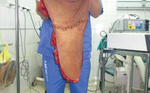 Rũ bỏ khối u đeo bám 24 năm