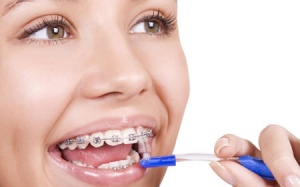 6 điều không thể bỏ qua khi niềng răng