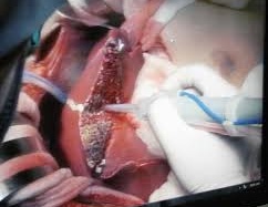 Việt Nam dự Hội thảo khu vực về cấy ghép gan và tủy