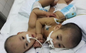 Tách rời hai bé trai dính nhau phức tạp