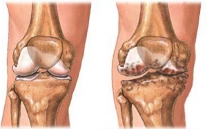 Chủ động với các bệnh cơ xương khớp