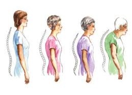 Hiểu đúng để phòng ngừa bệnh xốp xương