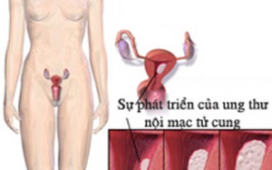 Nguy cơ ung thư nội mạc tử cung từ nước uống nhiều đường
