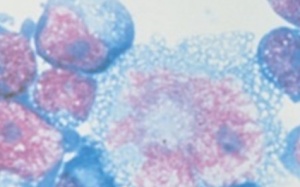 Phát hiện chủng HIV mới chuyển nhanh thành AIDS