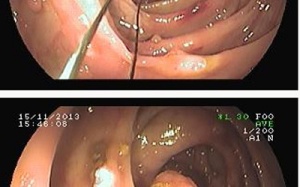 Nội soi cắt gần 40 u lành ở ruột già
