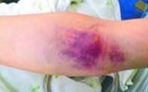 Bệnh nhi chảy máu chân răng kéo dài do ngộ độc thuốc diệt chuột