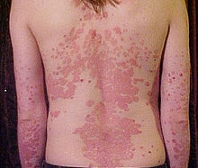 Điều trị vẩy nến mạn tính toàn thân bằng cách nào?