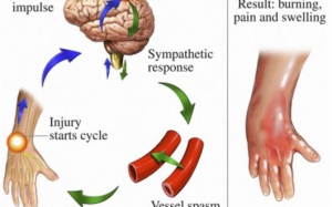 Bí ẩn cơn đau phức hợp