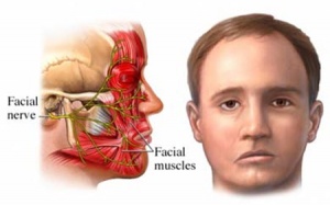 Phòng tránh liệt mặt mùa lạnh