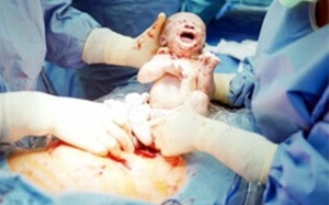 Một sản phụ được mổ cấp cứu tại nhà