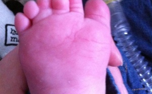 Bé trai có 12 ngón chân, 12 ngón tay