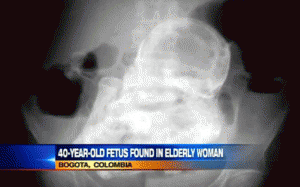 Bào thai 40 tuổi ngoài tử cung cụ bà 82 tuổi