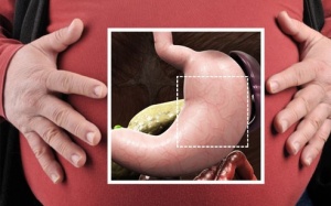 Giảm cân bằng phẫu thuật dạ dày: Bạn có sẵn sàng đánh đổi?