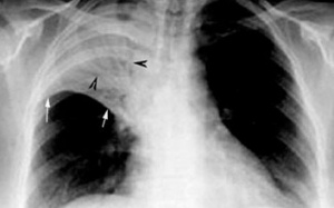 Viêm phổi do... rượu?!