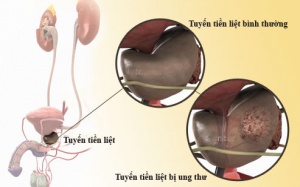 Tiểu ra máu ở người cao tuổi