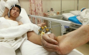 Dùng chân 'nuôi' tay trước khi nối lại