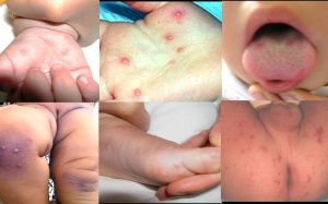 Bệnh tay chân miệng có dấu hiệu giảm