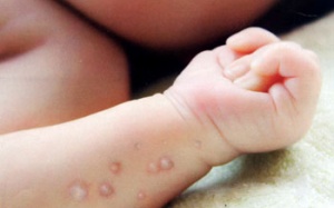 Bệnh tay-chân-miệng: Giảm con số mắc, tăng diện tích lây lan