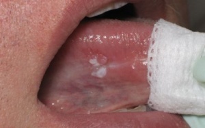 Nhận biết sớm ung thư lưỡi