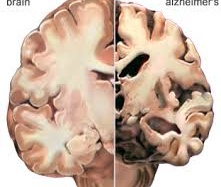 Phát hiện bệnh Alzheimer bằng cách chụp quét não