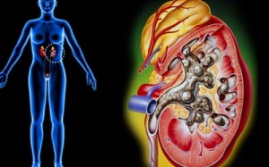 Việt Nam đang đối mặt với bệnh thận mạn tính