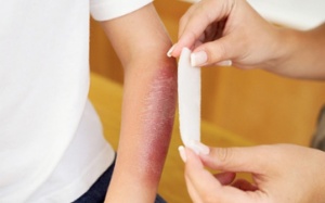 Lưu ý đặc biệt khi chăm trẻ bị bỏng